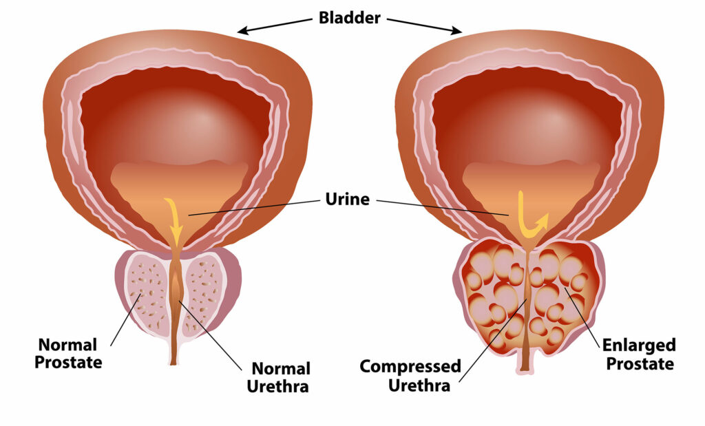 What are the Symptoms of Benign Prostatic Hyperplasia (BPH)? - Top  Urologist NYC