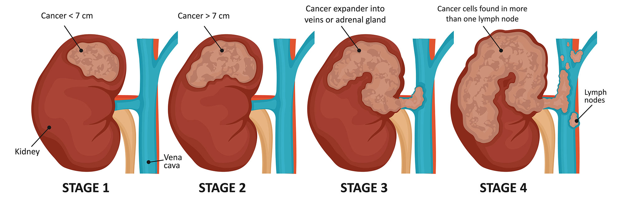 Kidney Cancer Stages