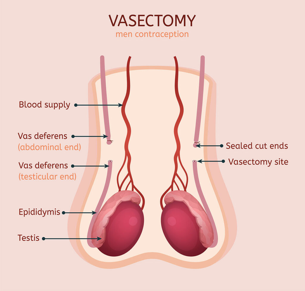 Vasectomy in Austin Texas